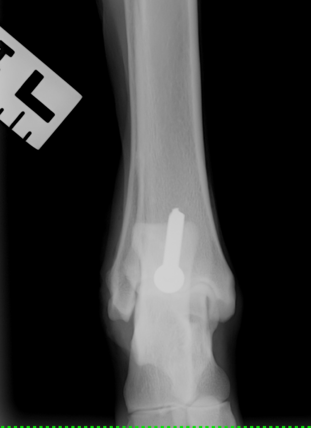 Ruby ankle x-ray