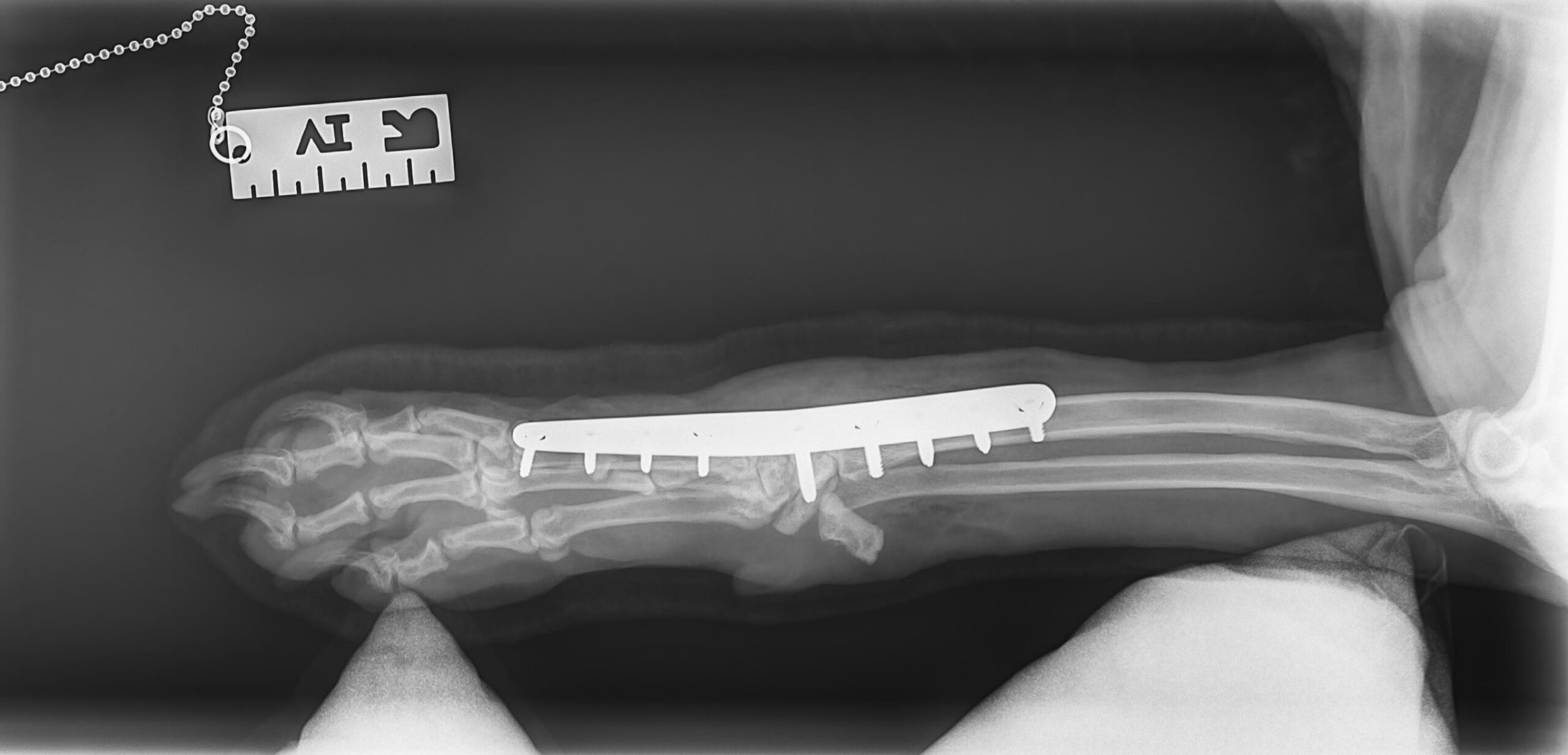 X-ray showing a bone plate implant after fracture repair surgery